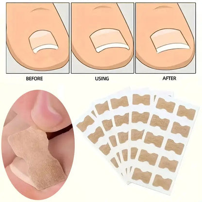 Toenail Correction Strips + Free Toenail Sticks